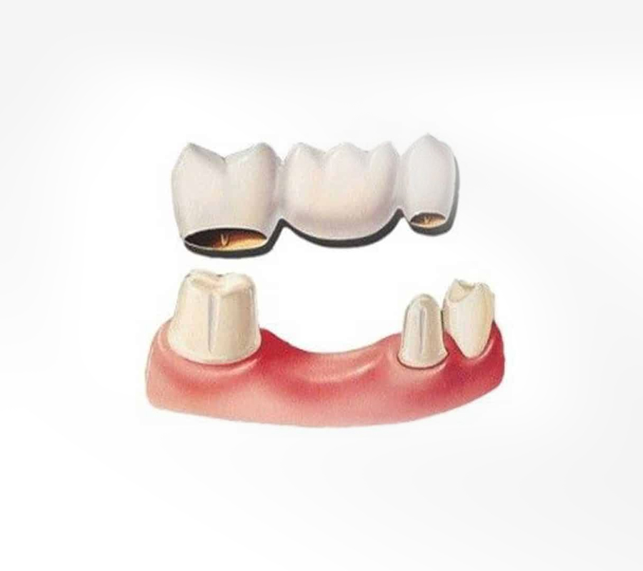 Dental Bridge Replacing Missing Teeth