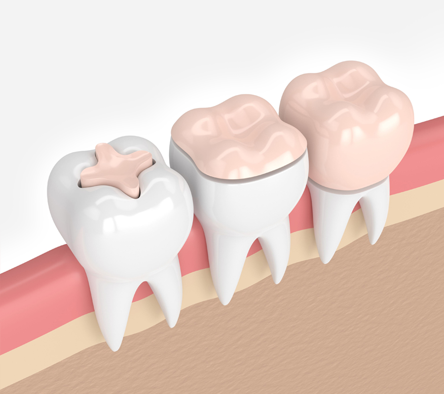 Dental Crowns