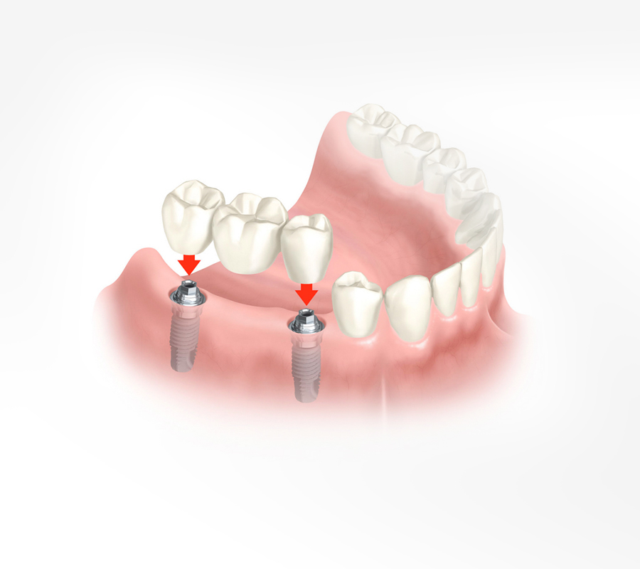 Dental Implants Replacing Missing Teeth