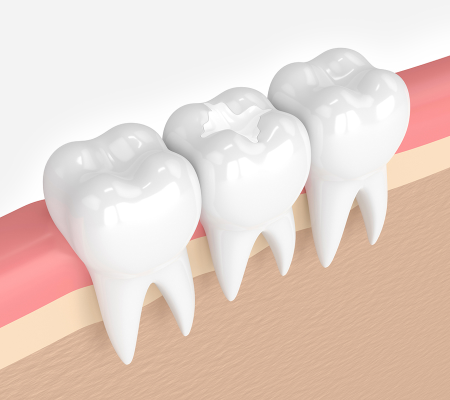 White Fillings White Fillings