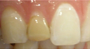 crown-before-1