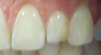 crown-before-2
