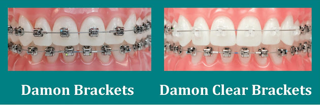 clear_and_metal damon braces