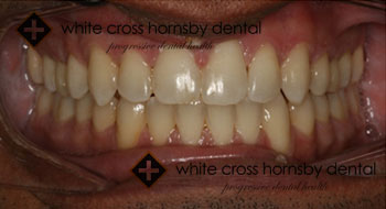 Invisalign-after-1