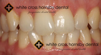 Invisalign-before-5