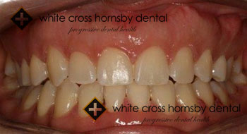 Orthodontics-after-10