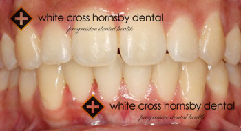 Orthodontics-after-11