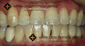 Orthodontics-after-12