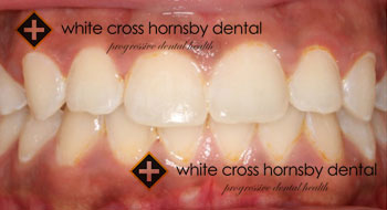 Orthodontics-after-13