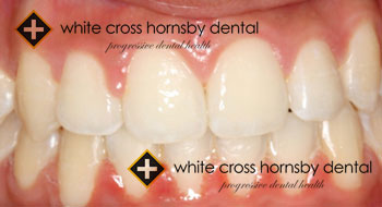Orthodontics-after-14