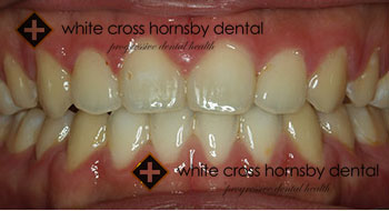 Orthodontics-after-15