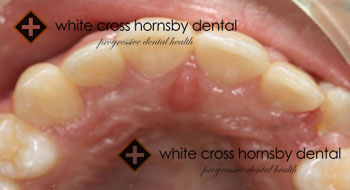 Orthodontics-after-16