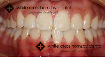 Orthodontics-after-2