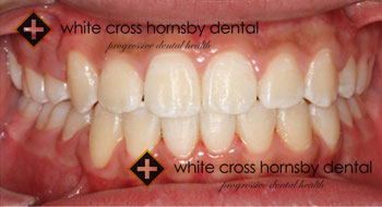 Orthodontics-after-3