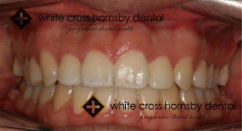 Orthodontics-after-5