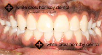Orthodontics-after-9