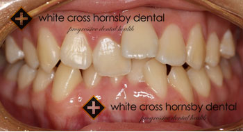 Orthodontics-before-1