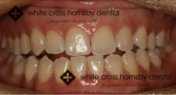 Orthodontics-before-10
