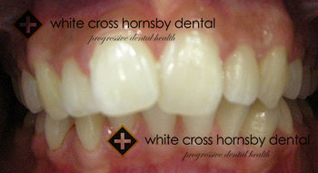 Orthodontics-before-11
