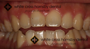 Orthodontics-before-12