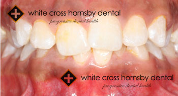Orthodontics-before-13