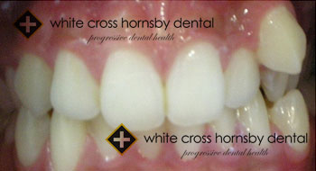 Orthodontics-before-14