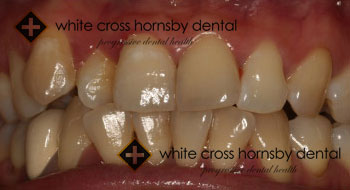 Orthodontics-before-15