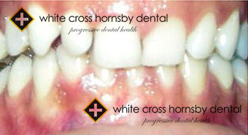 Orthodontics-before-17