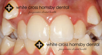 Orthodontics-before-18
