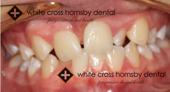 Orthodontics-before-19
