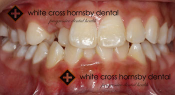 Orthodontics-before-2