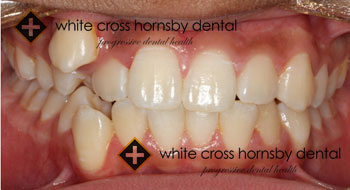 Orthodontics-before-3