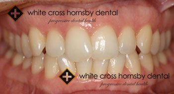 Orthodontics-before-4