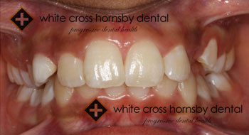 Orthodontics-before-6