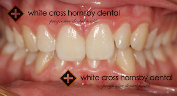 Orthodontics-before-8