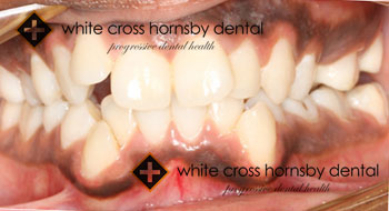 Orthodontics-before-9