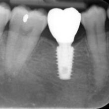 implant-4 Dental implant-4