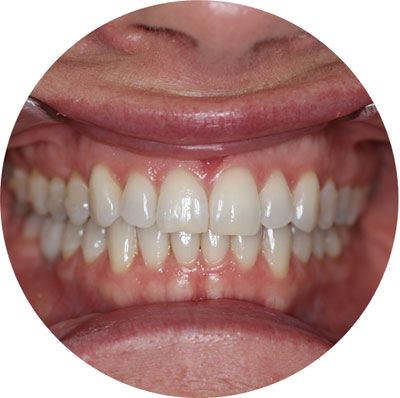 Teeth Whitening