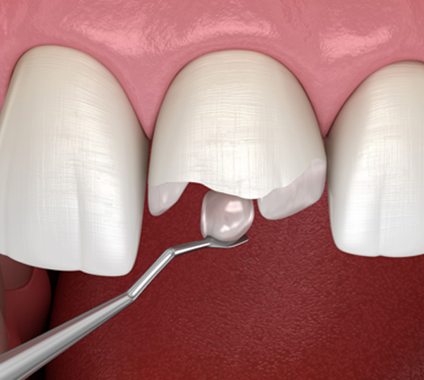 broken-tooth-or-filling broken-tooth-or-filling