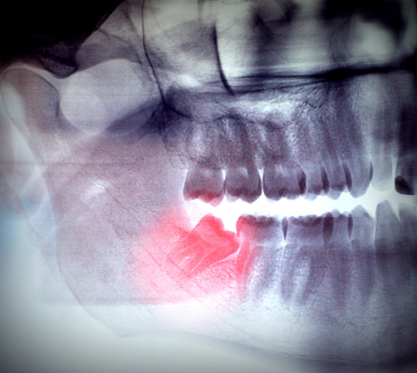 wisdom-tooth-pain wisdom-tooth-pain