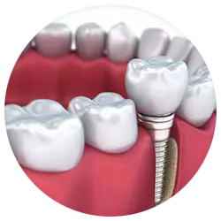 dental-implants