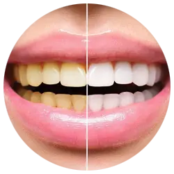 teeth-whitening-830x593-1
