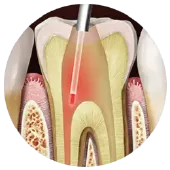 laser-assisted-root-canal-treatment-1
